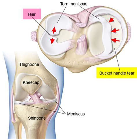 Torn Meniscus - Signs & Symptoms, Test, Diagnosis, Recovery, Treatment