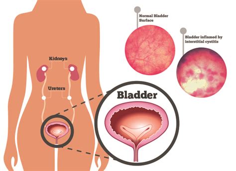 How to manage Interstitial Cystitis/Bladder Pain Syndrome?