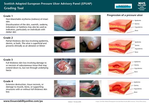 ulcer classification | Scottish Adapted European Pressure Ulcer ...