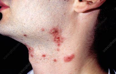 Shingles rash on the neck - Stock Image - C009/6837 - Science Photo Library