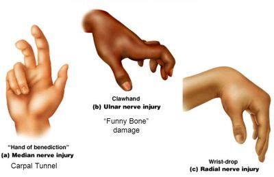 Ulnar Nerve Hand Deformity