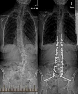 Scoliosis - Adult Degenerative Deformity - Sydney Neurospine