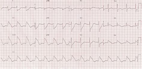 Inferior STEMI • LITFL • ECG Library Diagnosis