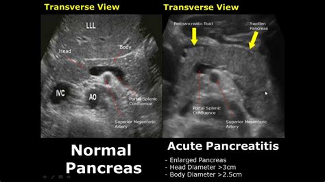 Pancreas Ultrasound