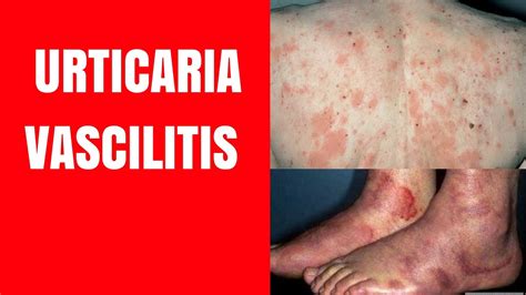 Urticarial Vasculitis - Types, Causes, Symptoms, Treatment