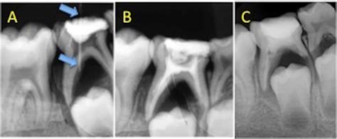 Periapical Abscess Radiograph