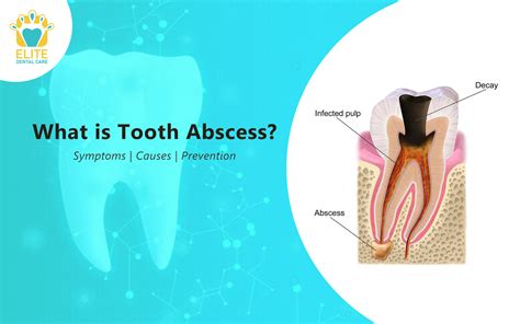 TOOTH ABSCESS: SYMPTOMS, CAUSES & PREVENTION | Elite Dental Care