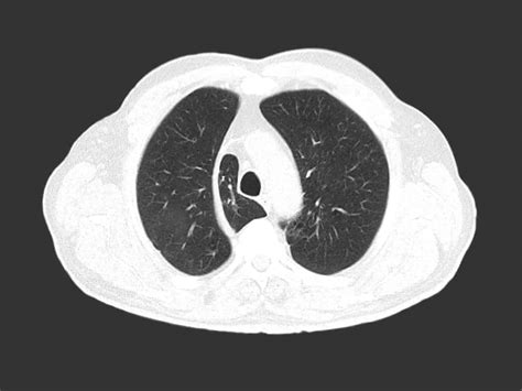 Chest CT - Insight Medical Imaging