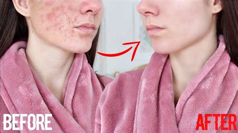 How To Get Clear Skin Overnight - Maybe you would like to learn more ...