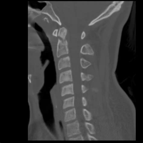 C-Spine Injuries + CT Interpretation – Core EM