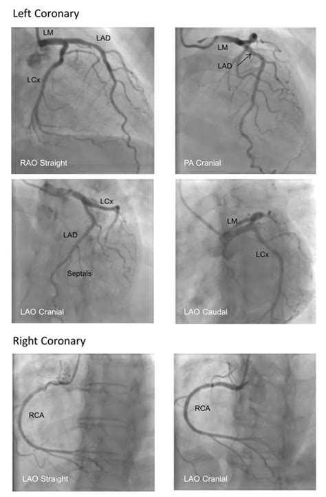 Coronary Artery Angiography : WFSA - Resources