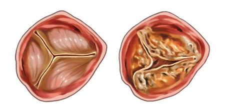 Tricuspid Stenosis – Notes Read