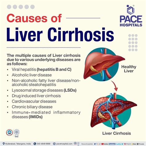 Liver Cirrhosis – Symptoms, Causes, Complications and Prevention