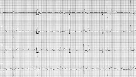 AV block: 2nd degree, “high-grade” AV block • LITFL • ECG Library