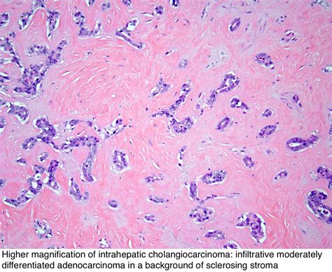 Pathology Outlines - Intrahepatic cholangiocarcinoma (small and large ...