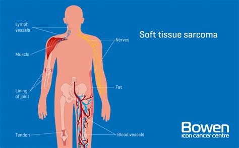 What is Soft Tissue Sarcoma? Soft Tissue Sarcoma Explained — Bowen Icon ...