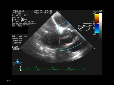 PPT - Trileaflet Aortic Valve PowerPoint Presentation, free download ...