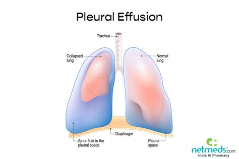 Lung Cancer Pleural Effusion