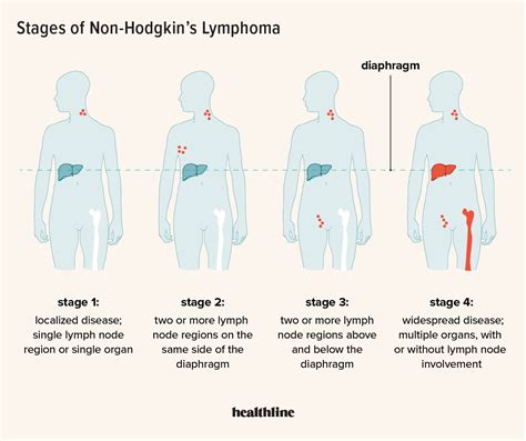 About non hodgkin lymphoma – Artofit