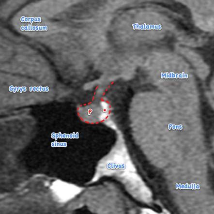 Pituitary Gland Anatomy Mri