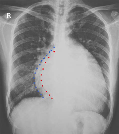 Mitral Regurgitation Xray