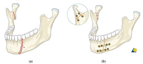 Materials | Free Full-Text | A Mandible with the Temporomandibular ...