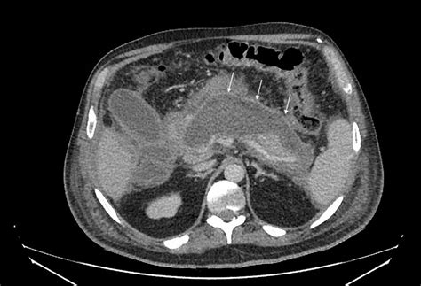 Acute necrotizing pancreatitis with walled off necrosis (WON). A ...