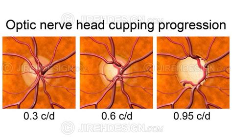 Optic disc cupping progression - #CO0052 - Stock eye images