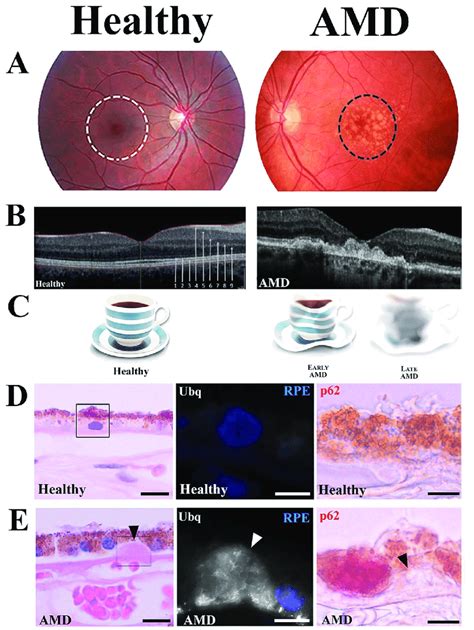 Macular Degeneration Symptoms