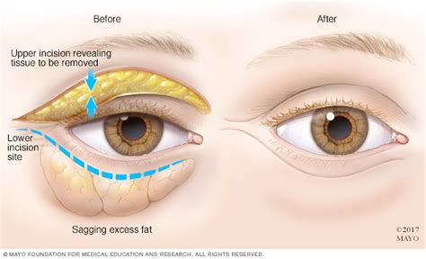 Bags under eyes - Diagnosis and treatment - Mayo Clinic