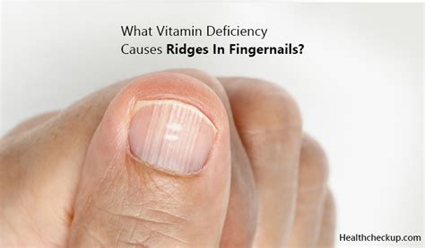 What Vitamin Deficiency Causes Ridges In Fingernails?