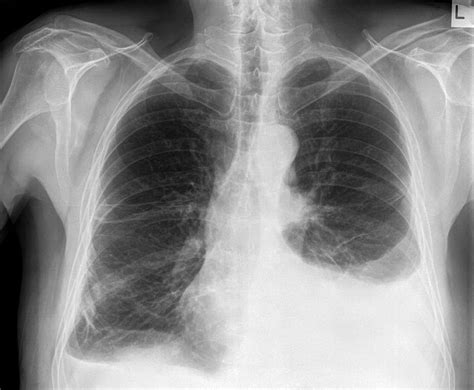 Pleural Effusion On Chest X Ray | Images and Photos finder