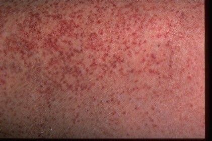 What Causes Tiny Red Dots on Skin? | New Health Advisor | Skin red dots ...