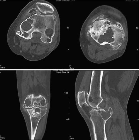 Multiple huge subchondral cysts associated with pseudogout in the ...