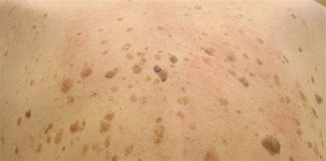 Seborrheic Keratosis FAQ - Vista Dermatology