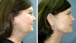 Non-Surgical Alternatives to Neck Lift - AHB