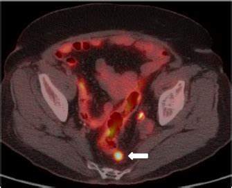 Mesorectal node metastasis from gynecological cancer in the era of 3D ...