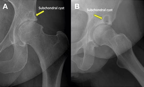 Surgical Treatment of Subchondral Bone Cysts of the Acetabulum With ...