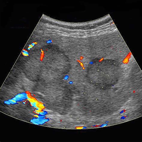 Liver metastases, color doppler ultrasound [3 of 3]