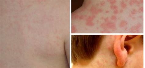 Amoxicillin Rash: Types, Causes, Symptoms and Treatments