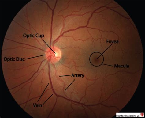 Fundoscopic Exam (Ophthalmoscopy) | Stanford Medicine 25 | Stanford ...