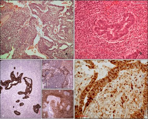 Pulmonary blastoma: a case report and review of the literature | BMC ...