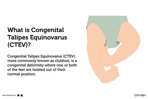 Congenital Talipes Equinovarus (CTEV): Causes, Symptoms, Treatment and Cost