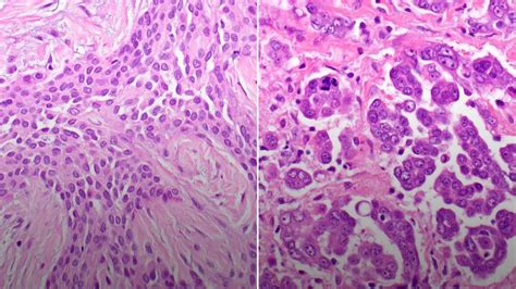 Pleural Mesothelioma - YouTube