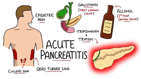 Acute Pancreatitis - Causes, Signs & Symptoms, Pathophysiology ...