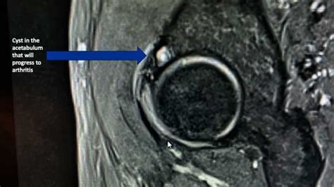 Hip Cysts | Acetabular Paralabral Cyst & Subchondral Cyst | FAI ...