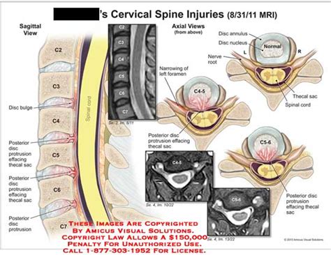 AMICUS Illustration of amicus,injury,cervical,spine,MRI,disc,bulge ...