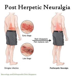 Post Herpetic Neuralgia | Comprehensive Nerve Clinic