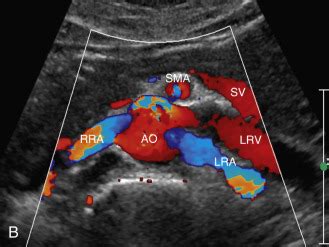 Duplex Ultrasound of Native Renal Vasculature | Radiology Key