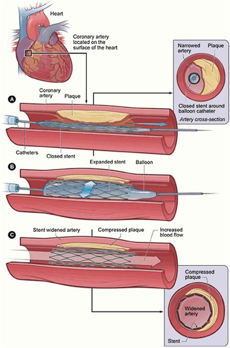 Restenosis, in-stent restenosis causes, symptoms, diagnosis, treatment ...